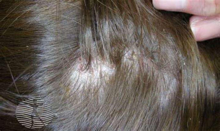 Head Lice