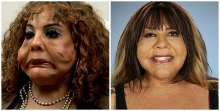 See the Most Extreme Plastic Surgery Transformations From ‘Botched’!